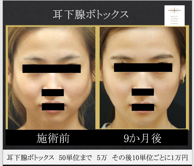 小顔ボトックス 唾液腺 耳下腺 へのボトックス 効果と副作用について 西田美穂のボトックスマニア