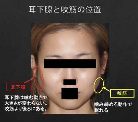 小顔ボトックス 唾液腺 耳下腺 へのボトックス 効果と副作用について 西田美穂のボトックスマニア